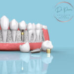 Group logo of Dining Delights: Eating Well with All-on-6 Implants (Doctorprem)