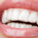 Group logo of Dining Delights: Eating Well with All-on-6 Implants